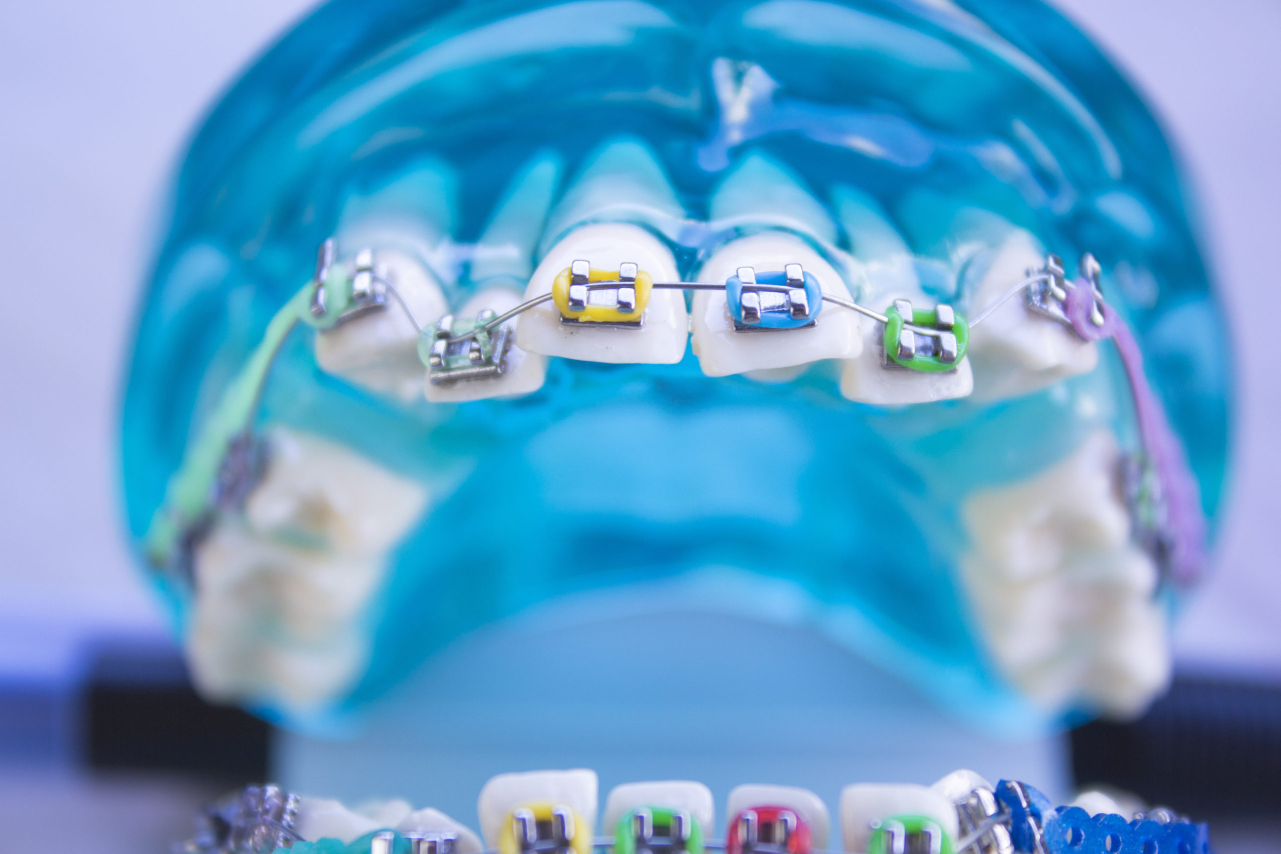 How To Pick The Best Color Palette For Your Brackets Reddick Orthodontics