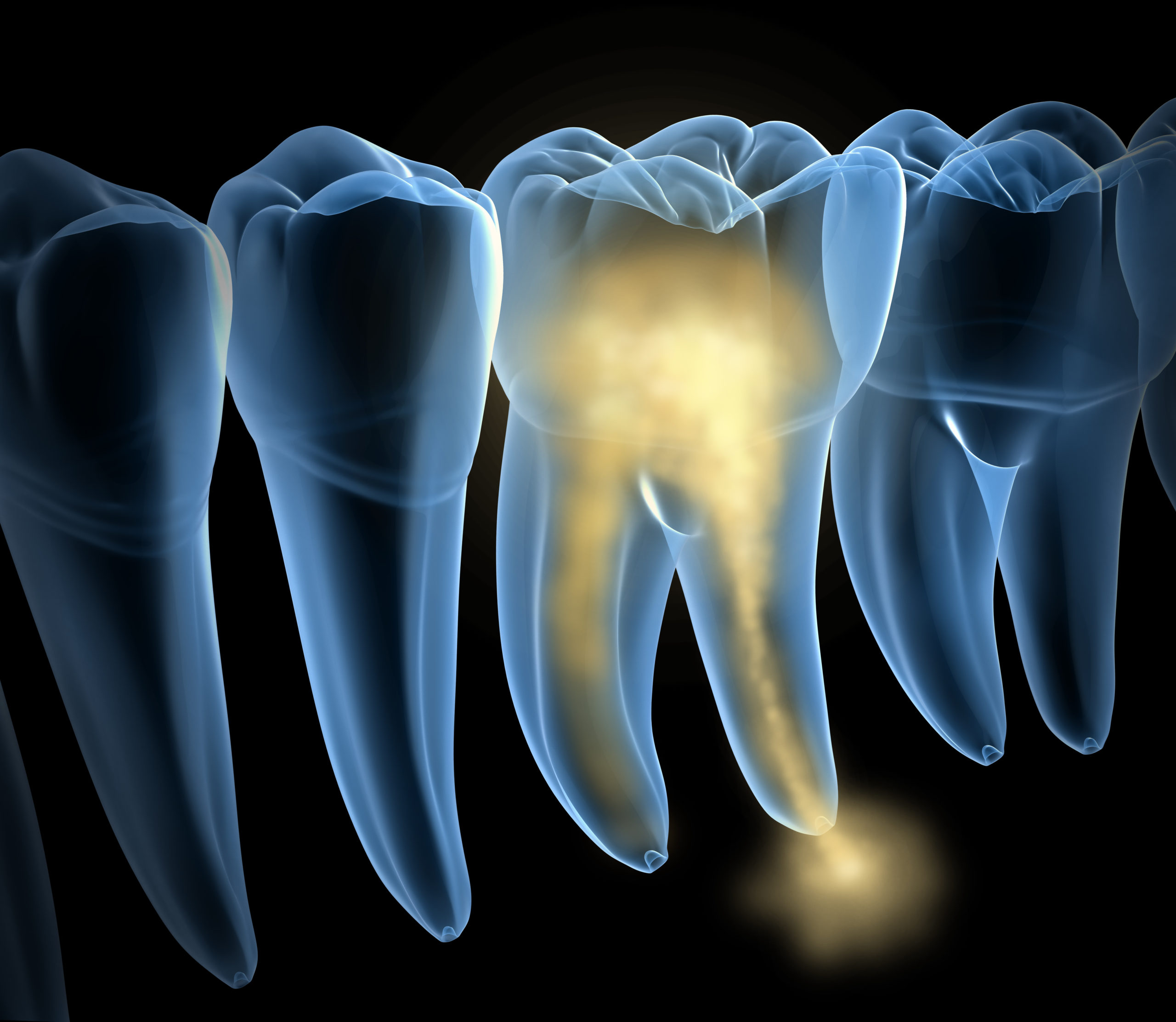 damaged-molar-teeth-xray-view-medically-accurate-tooth-3d-illustration