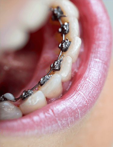 All About Lingual Braces - What You Need to Know about these Invisible Metal Braces