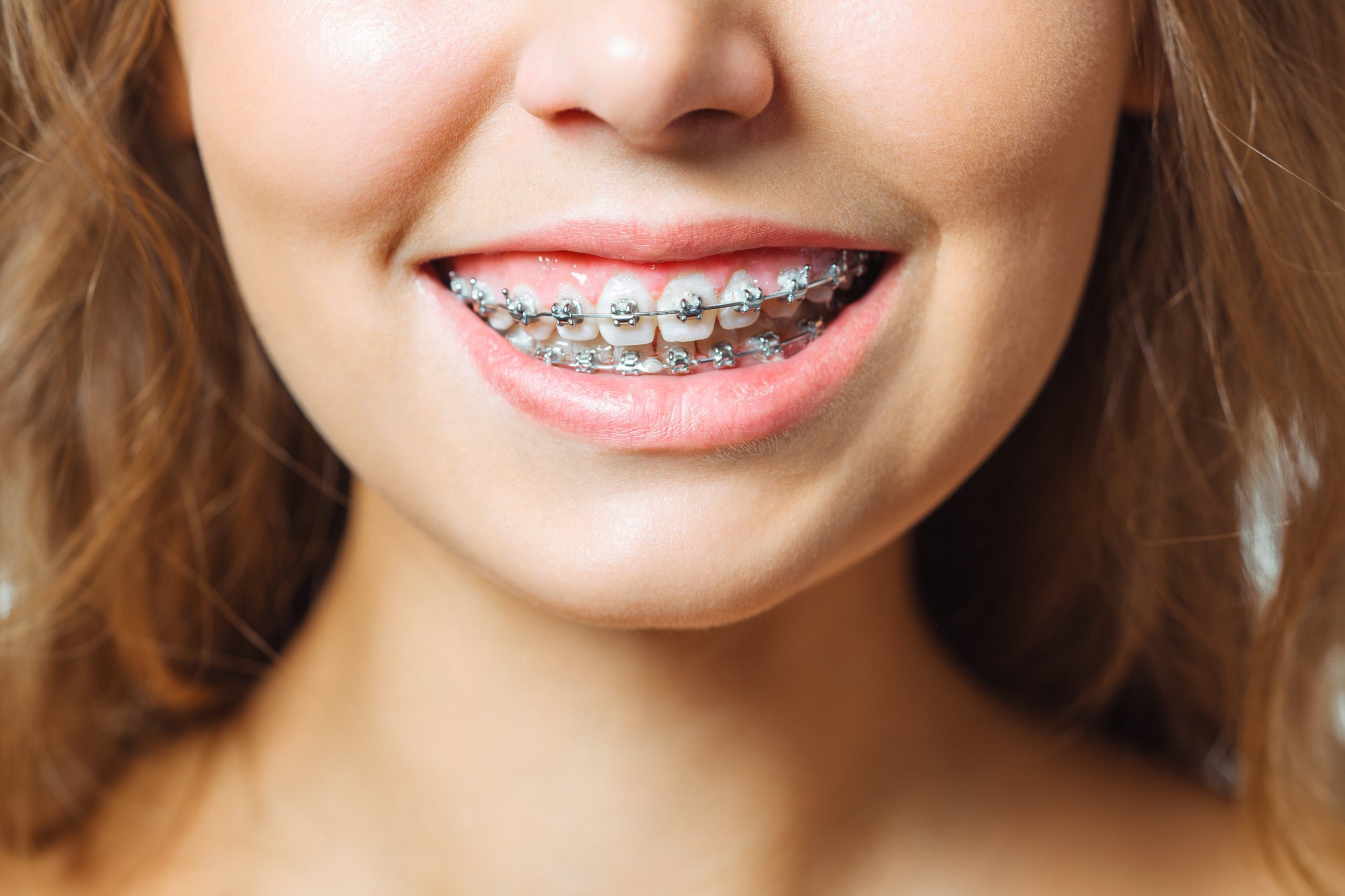 Girl with Gummy Smiles showing Orthodontics