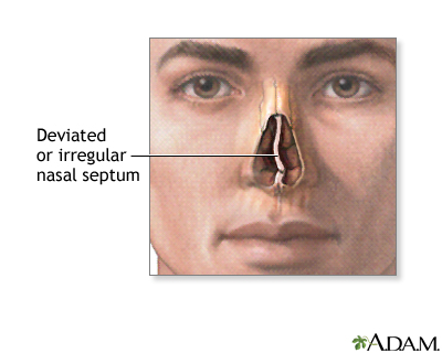 Septal deviation