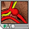Aneurisma cerebral