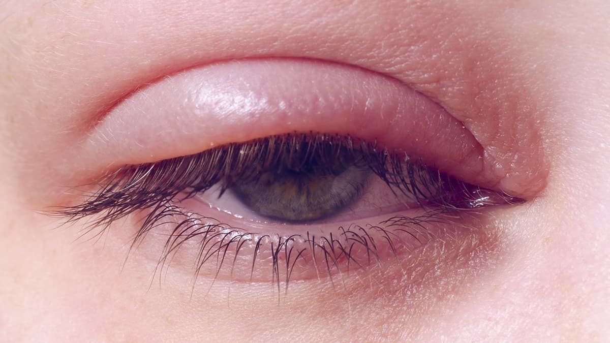 Desodorantes naturales: belleza y cuidado de la piel 17 caspa en las pestañas