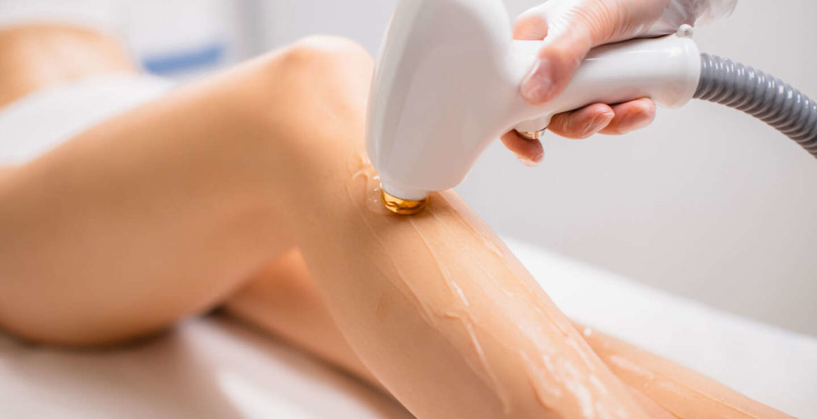 depilacion laser lunares