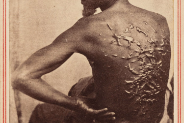 “The Scourged Back” shows the scarred back of escaped slave Peter Gordon in Louisiana, 1863. (McPherson & Oliver/National Gallery of Art)