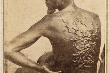 Raised scars on the back of a formerly enslaved man.