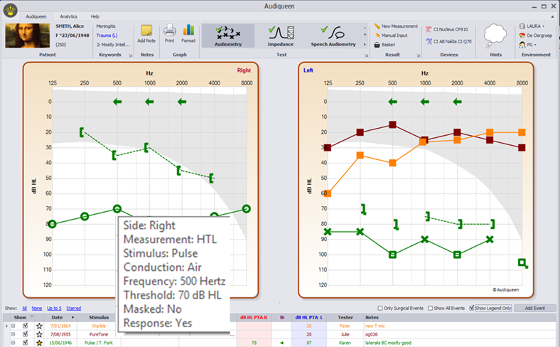 Typical Audiometry screen. Several results of different dates are superposed on the graph. These results have been selected by means of the check boxes in the list. More details are given in the small window which pops up when hovering the mouse over a threshold point. In this case, it reveals that the threshold was 70 dB HL, right ear, obtained with a pulse tone of 500 Hz through unmasked air conduction
