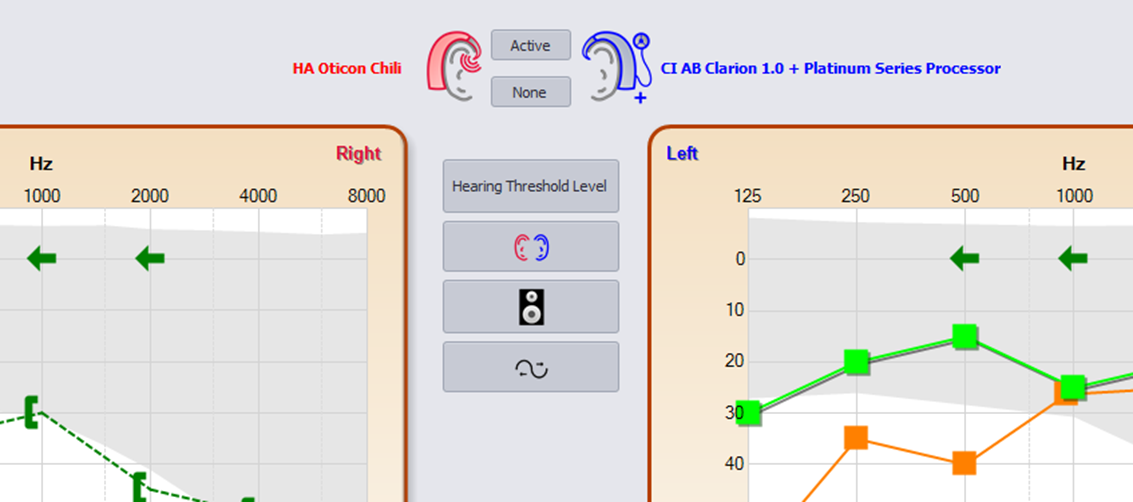 Here the audiograms are obtained in an aided condition, with a hearing aid (Oticon Chili) at the right side and an implant (AB Clarion) at the right side.