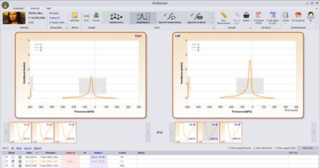 Typical screen showing the Y, G and B curves of the impedance measurement, and the stapedial reflexes as measured at different intensities between 80 and 110 dB (in this case ipsilateral reflexes).