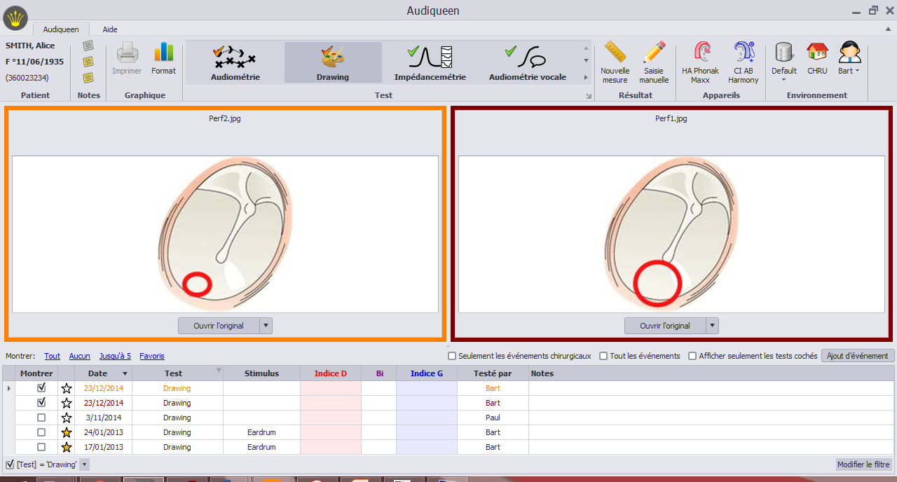 Figure showing the results under test type ‘Drawing’. The user can open preconfigures drawings, add his own annotations and save the result.  Here, for instance, the evolution of a tympanic membrane perforation is shown.