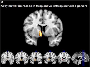 Grey Matter Brain Scan Grey Matter Brain Scan