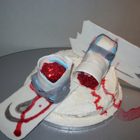 Snowboard Accident Broken snowboard, with foot stumps