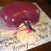 Dave's Kidney Dave's real kidney was being bid fair-well at a surprise party thrown by his wife. The couple participated in a 3-way kidney donation...