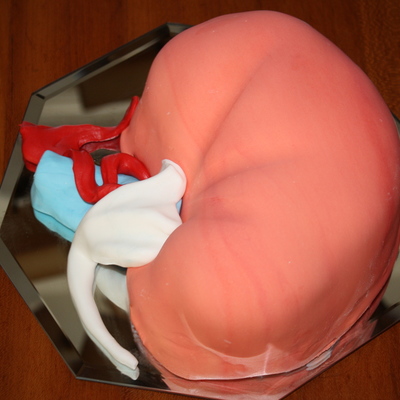 Kidney For A Transplant Recipient