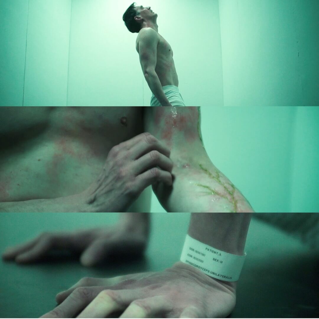 A man with a fungal infection and patient ID wristband stands in an examination room.