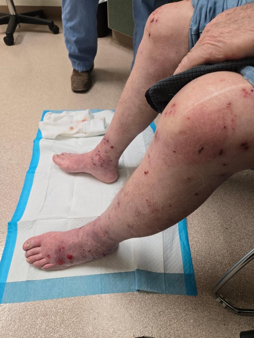 Got Mr Barlow in to the doctor today. This was getting so much worse and swelling a lot more. He is all wrapped up now and they took a culture to find out exactly what it is. He goes back on Thursday and will find out then