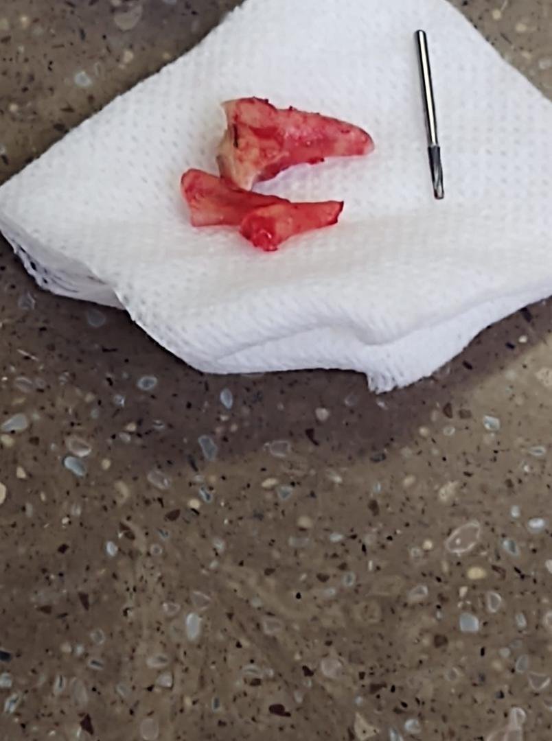 Spent the whole morning getting the molar pulled out that was anchoring my bridge that will have to be replaced. My dentist will definitely not need a PPP loan. Okay I just have to post the picture of it, It's the anesthes