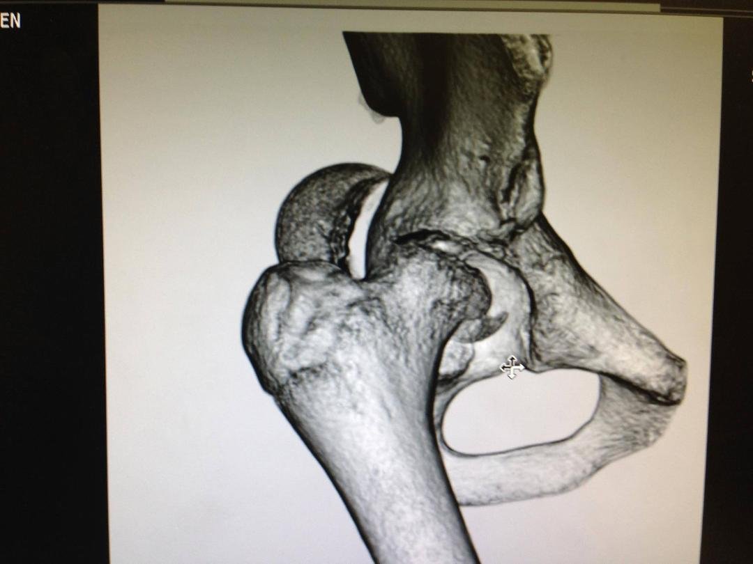 Owens hip before surgery