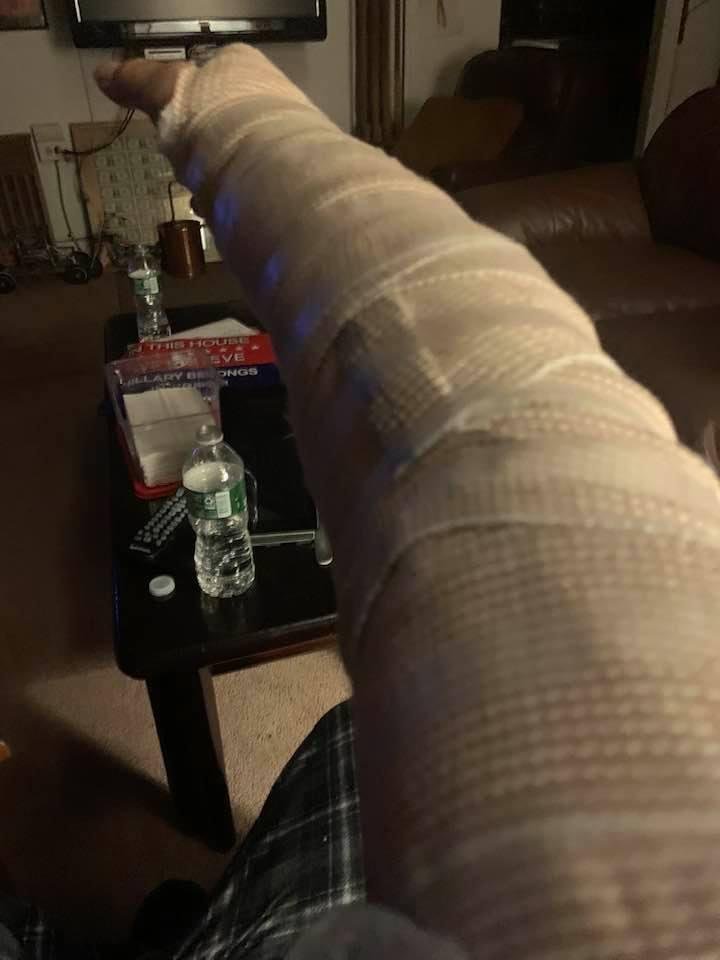 Surgery went well should be in good shape in about two weeks