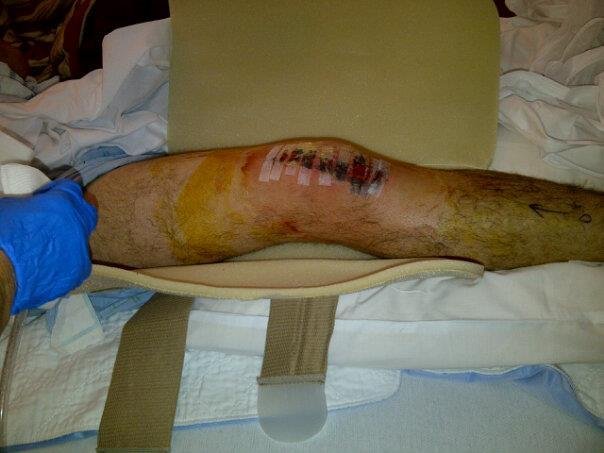 Kyles knee...