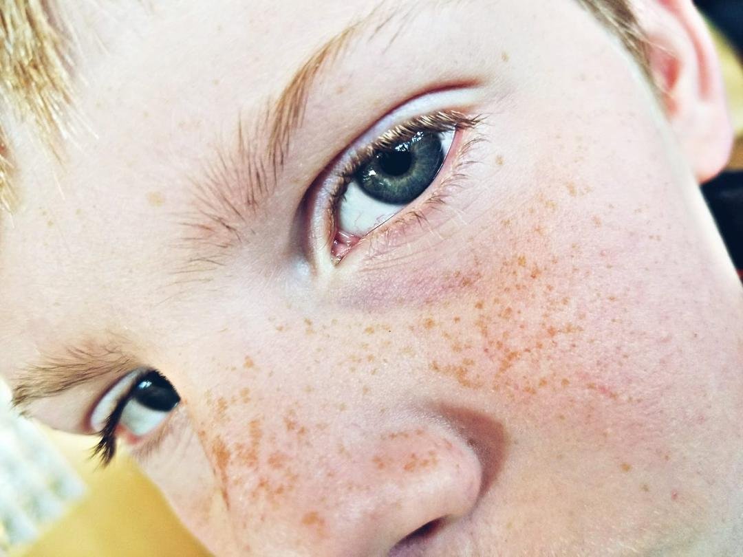 I ♥️ freckles