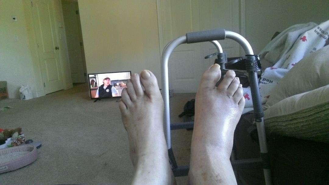 one day short of two weeks, bruises gone after two epson saltz baths