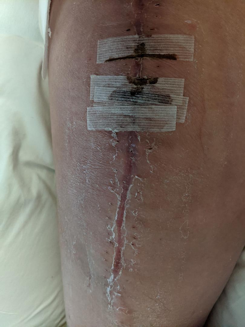I don't know but Shane Falco aka Keanu Reeves in the movie The replacements says chicks dig scars I don't know if I was a chick and I saw this scar I think I would run I wanted to but couldn't..