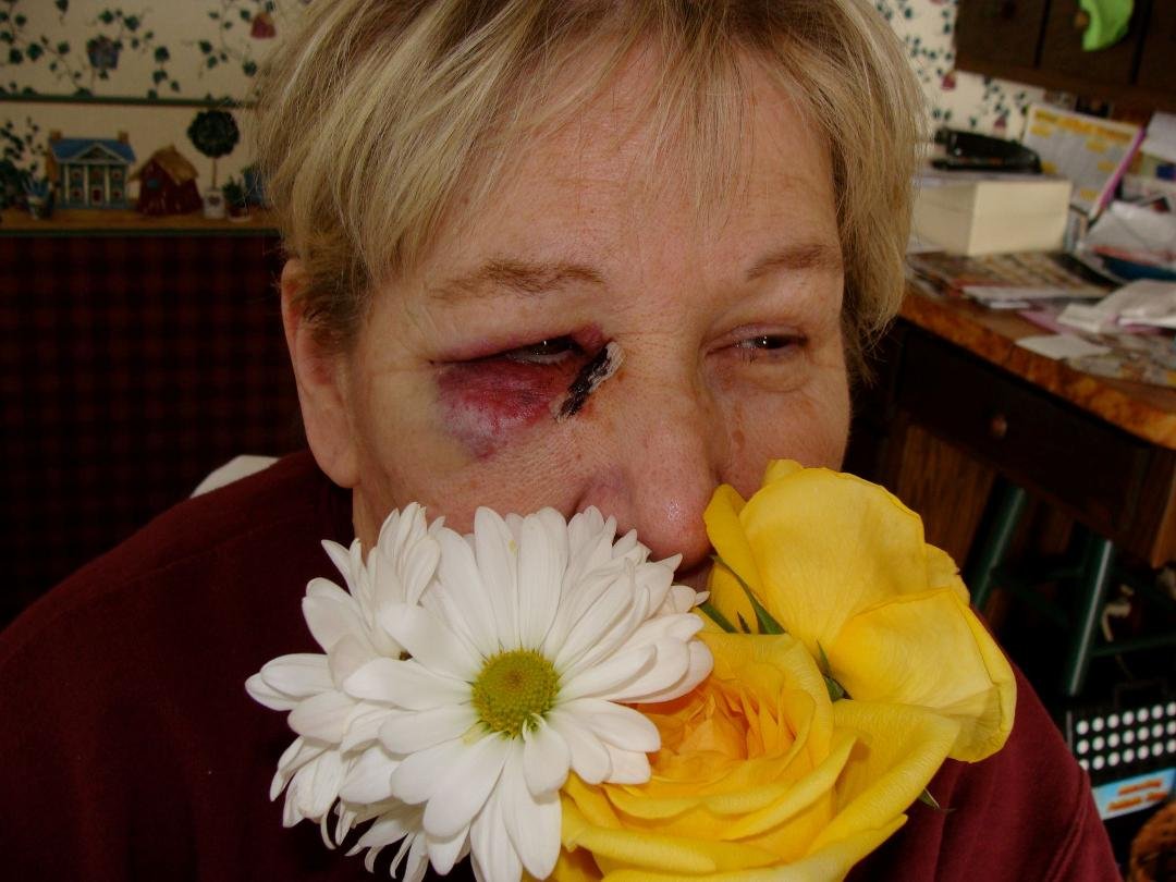 I went to see Carole Weakland today and found her with this.   She said, " you should have seen the other guy".    All kidding aside, she had eye surgery and it's slowly coming along.   Good luck Carole and before ya know i