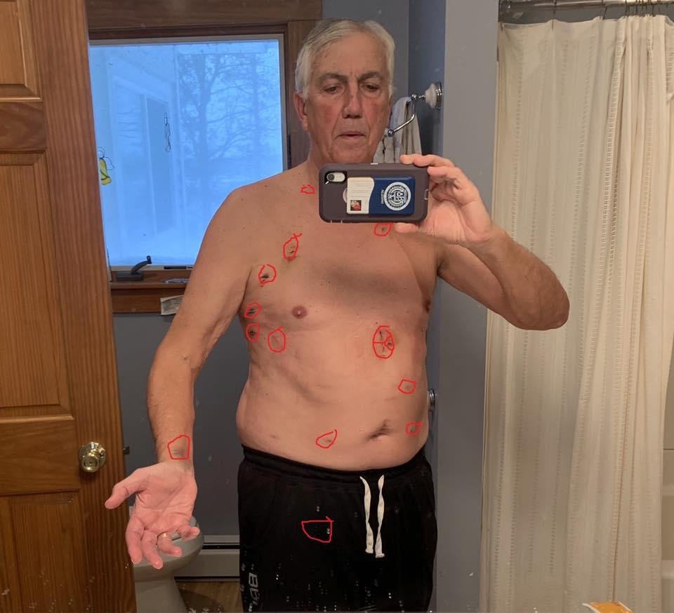 12/31 I thought I’d check how I was healing from this minimally invasive surgery. I’m counting 15 entry points to my pericardium along with drainage sites and shunts. Please excuse that I lost my Arnold Schwarzenegger upper