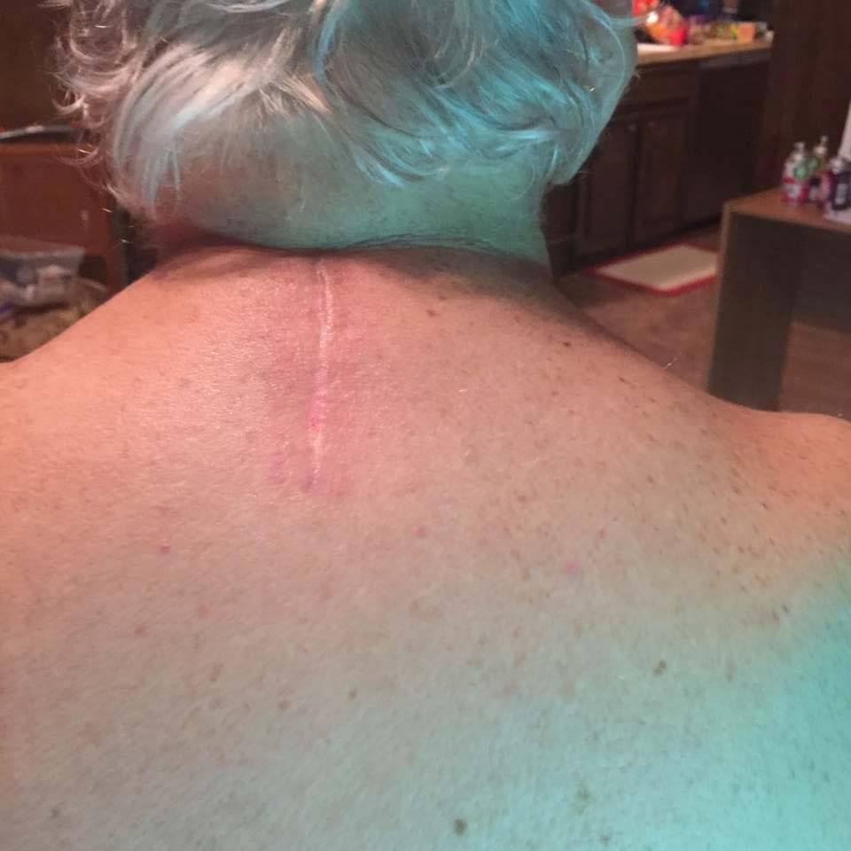 Been in the rehab center getting over back surgery