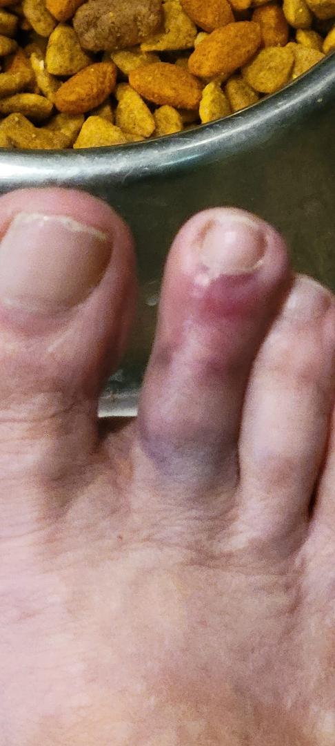 2nd day of camping. Got up too fast and that toe did not straighten out like the rest. Ooo that hurt!