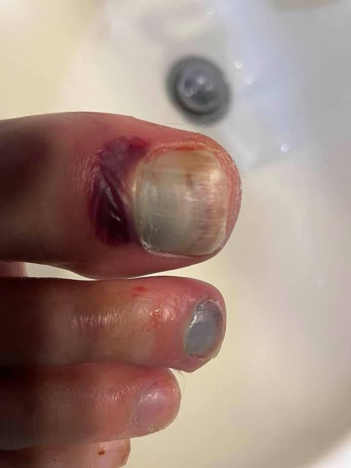 WOW! Took off my sock last night getting home and saw this. Yeah, it’s bad, but worse I felt very little pain. Guessing this is from the collision where I rear ended another car. I contribute little pain with some enlighten