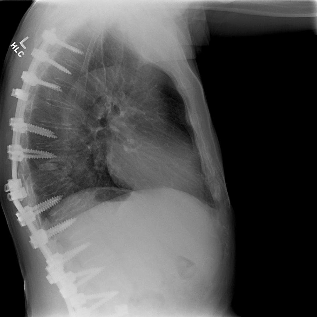 Do you think I have enough screws in my back? Very painful.