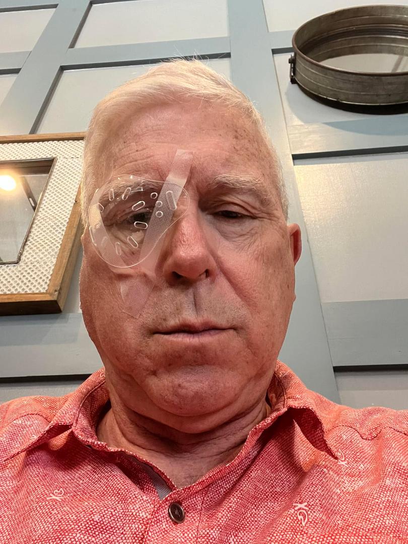 First cataract done!