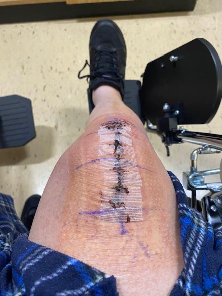 The outer bandage came off today, June 21. The operation was June 5.
The strange writing on the knees says: yes, this is the knee!