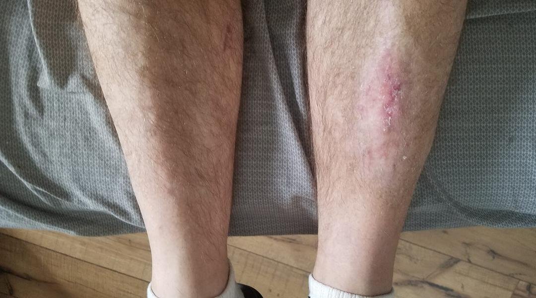 So that's where the bones were sticking out. Feeling like new.