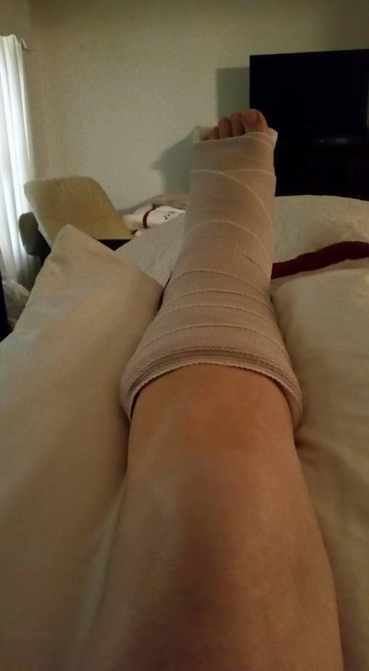 Back from my 1st post-op visit. Still have some swelling but look. ..a shorter cast and a week from today I'm getting a boot!