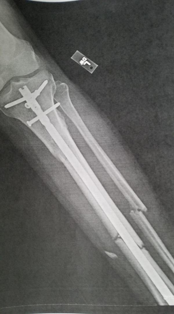 Would you walk on this? I do ! Doc says no running or weight lifting. (today's x-ray)