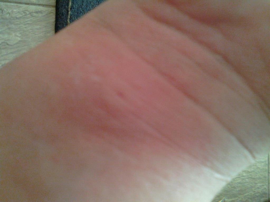 man i got a bee stung today, and it has bruised my wrist muscle. hurts to bend it