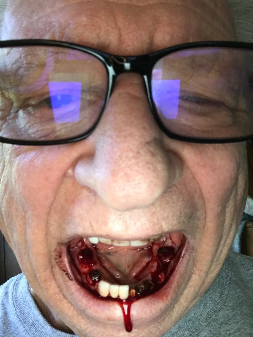 Stage two [  four implant's ] 12/16/2020