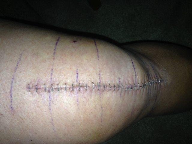 Left knee after replacement