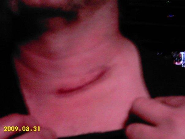 If anybody has thoughts of Neck Surgery, DON'T, I am 3rd full day post-op and in painbut not anything I can't handle Trying not to take the Percocets.doing good so far.