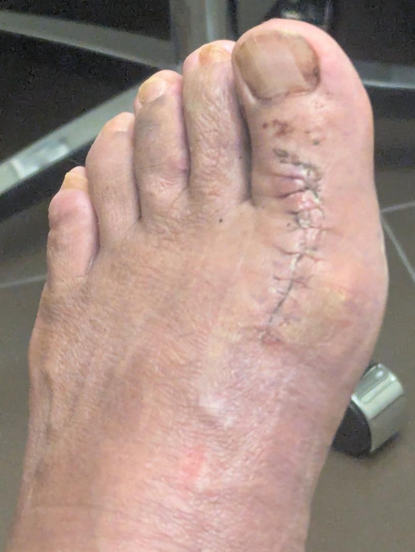 Got my stitches out today. I think my foot modeling career is over
