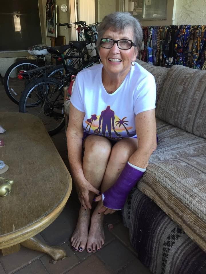 Val and Gini, I took your advice and got fingernails and toenails matching my cast! You can see them better if you magnify the photo, but that also brings out the matching varicose veins! Purple nails and cast go nicely w
