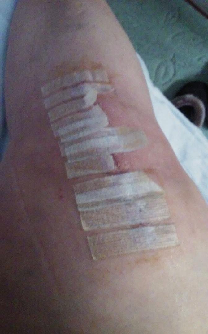 Looks pretty good for 2 weeks out ,they say after this 3rd week l will feel much better ,proud of my self for finally getting it done.