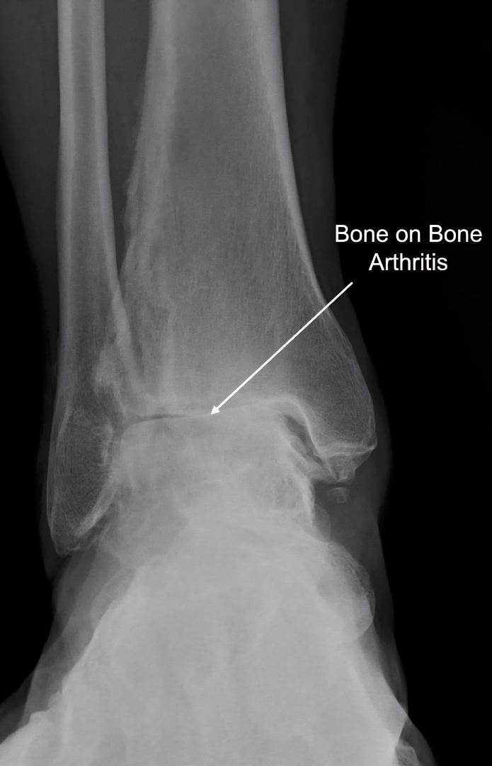 RESULTS:
So...doc says the side ankle joint is just irritated but still has cartilage. Unfortunately, front ankle joint is already bone-on-bone. 😭 He suggested a "bone fusion". The front ankle bones would be fused using sc