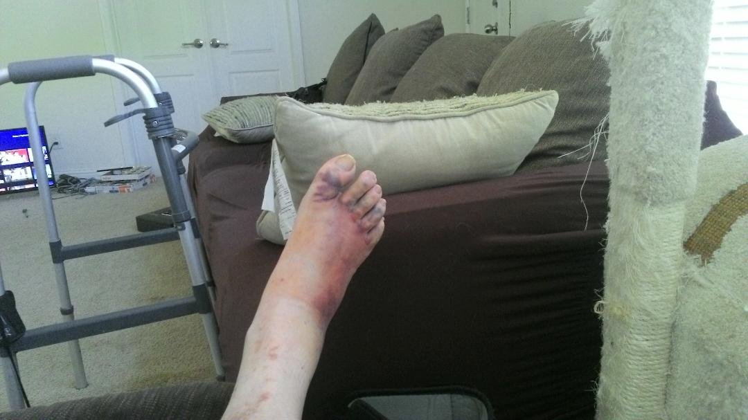 Well, its been four days, but its still swollen