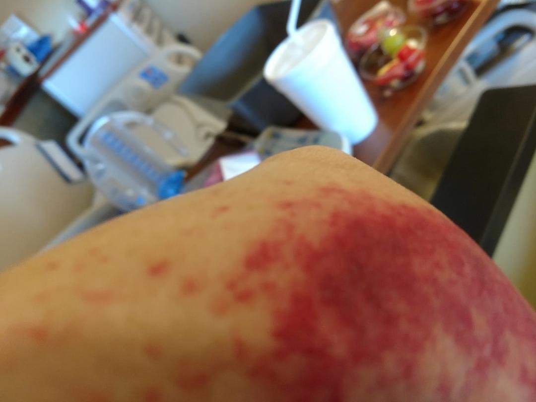 Heres my rash people!