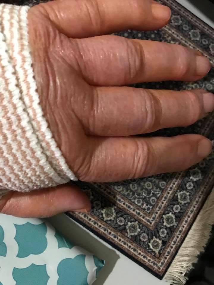 Well, left hand done early this morning, carpal tunnel release. Swelling down some in thumb and forefinger and feeling is pretty normal but the others are very swollen and feeling is slower coming back. I hear that is norma