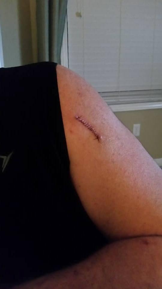 It's not a centipede it's B cell carcinoma.  Use sun screen. ☉☂😎